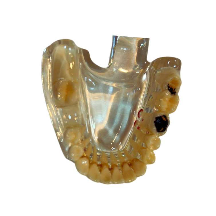Modelo de Patologia Odontológica Transparente