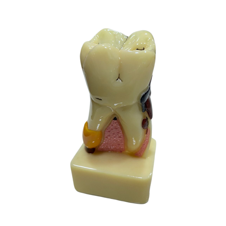 Modelo de Dente Molar Ampliado - Saudável e com Cárie