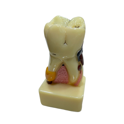 Modelo de Dente Molar Ampliado - Saudável e com Cárie