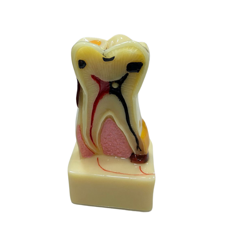 Modelo de Dente Molar Ampliado - Saudável e com Cárie