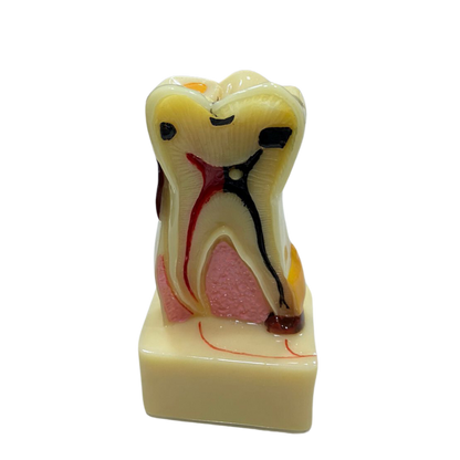 Modelo de Dente Molar Ampliado - Saudável e com Cárie